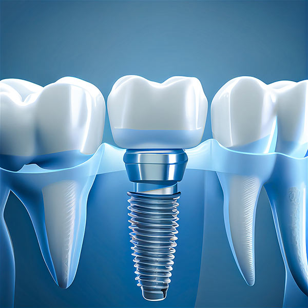 Implanty zębów kluczem do pięknego uśmiechu i sukcesu w życiu osobistym i zawodowym